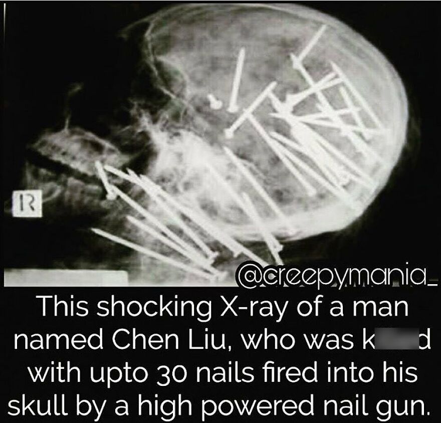 A shocking X-ray of a skull with nails, a terrifying fact and horror story example.