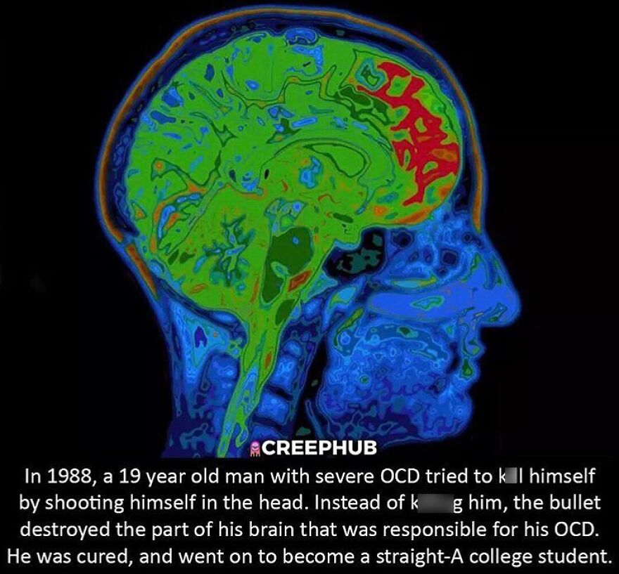 A brain scan showing highlighted areas, illustrating a terrifying fact about a man with OCD who survived a bullet.