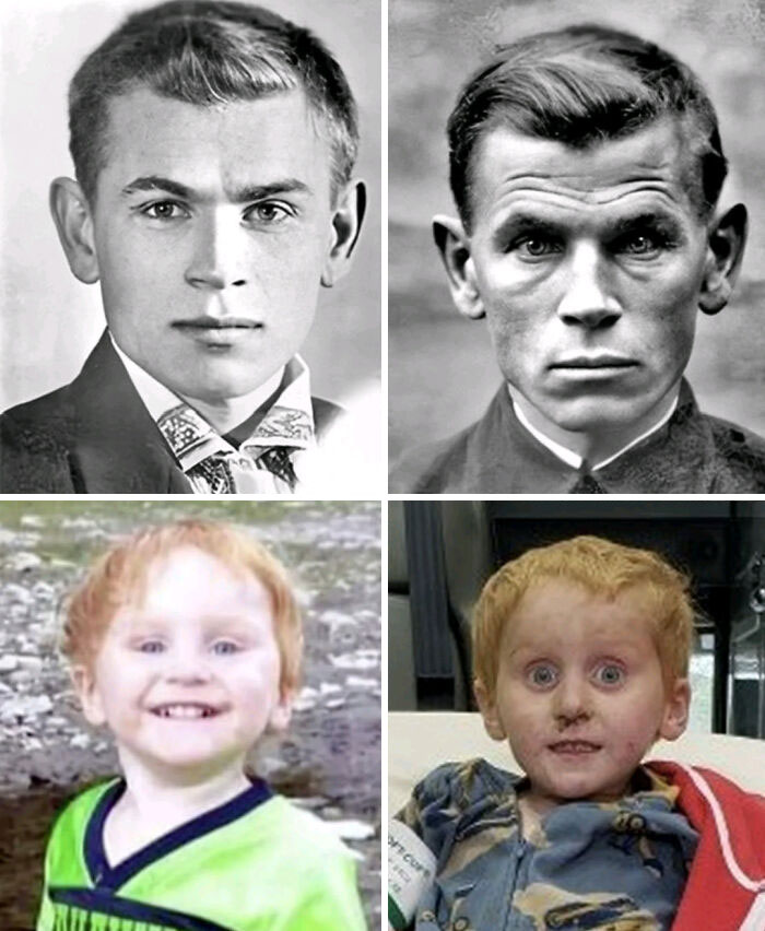 Before and after photos of people showing aging and illness effects