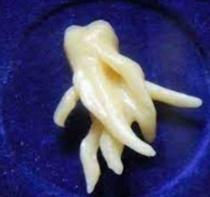 Tooth with weird elongated roots resembling tentacles on blue background