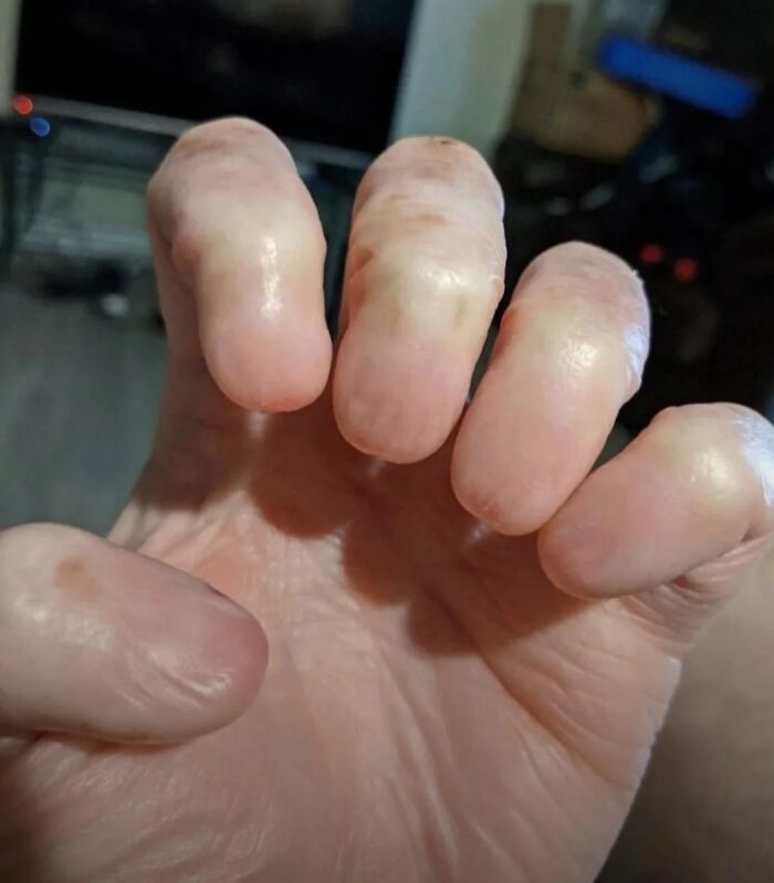 Close-up of swollen fingers with shiny skin and unusual rounded shapes