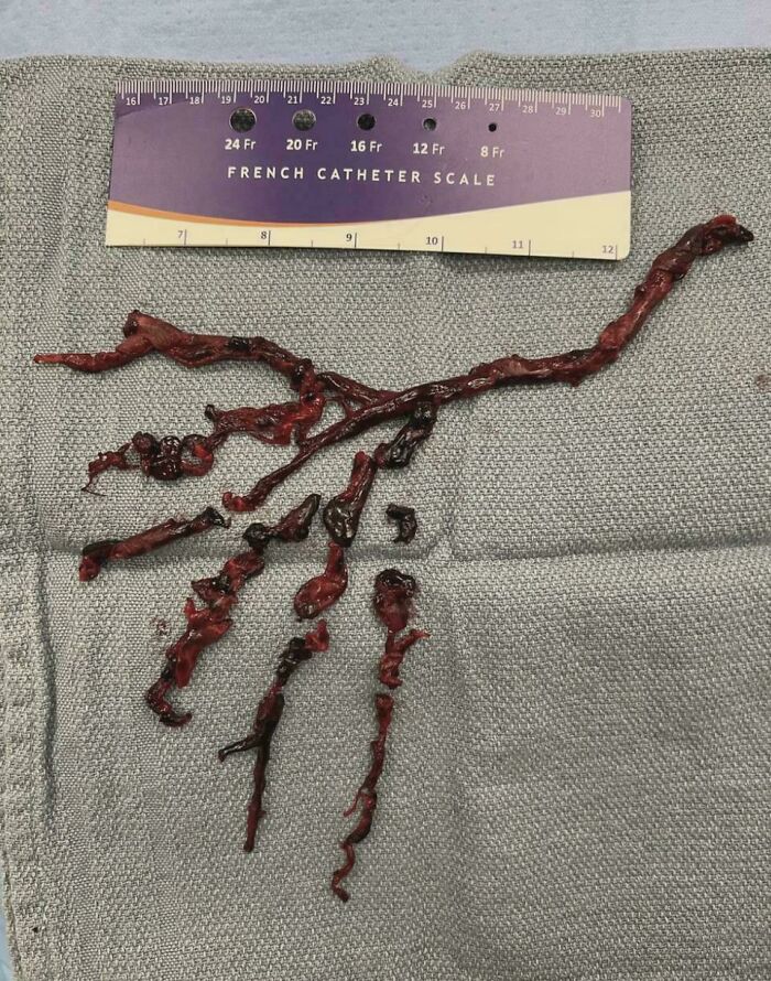 Extracted blood clot with French catheter scale measuring size