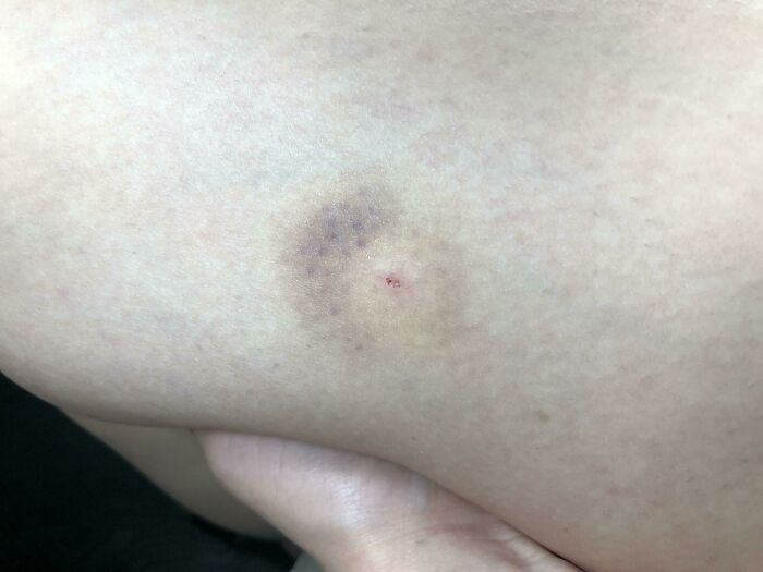 Close-up of a skin bruise with discoloration and slight swelling