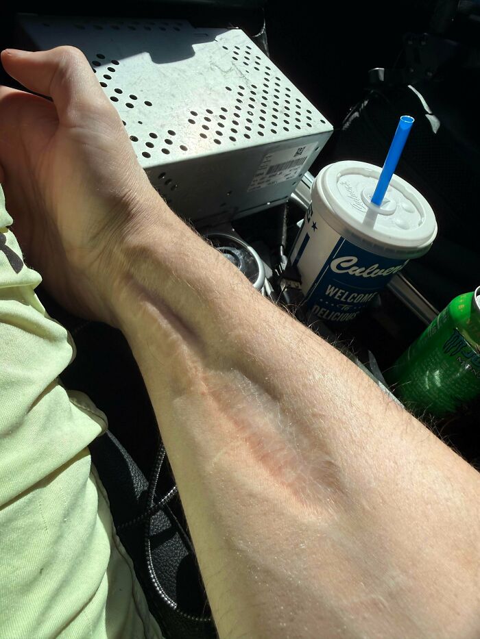 Forearm with prominent scar tissue highlighted by sunlight showing skin quirk
