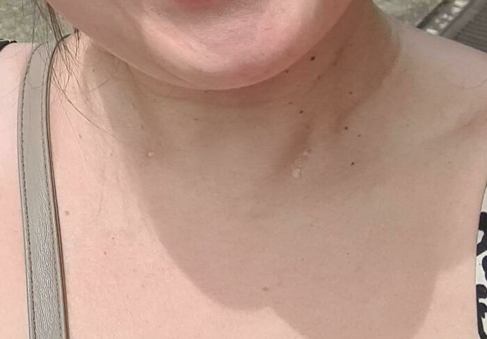 Close-up of human skin with multiple small moles showing unique body quirks