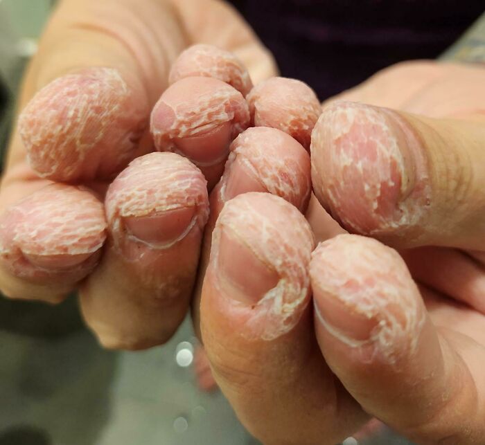 Fingers with flaky dry skin showing human body quirks