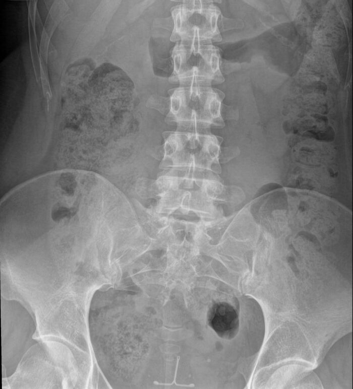 X-ray image showing human body quirks with spinal and pelvic anatomy visible