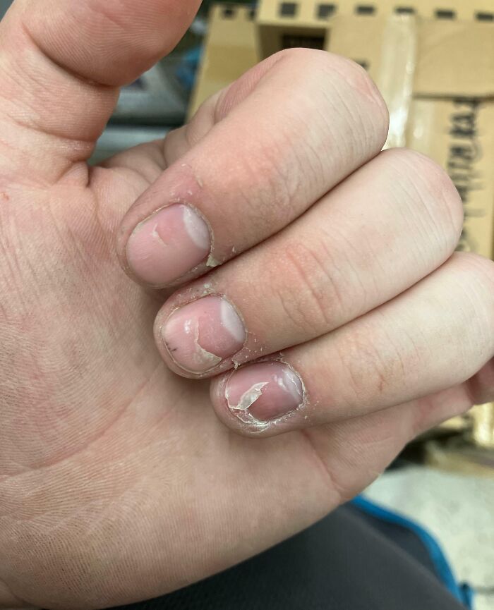 Hand with peeling fingernails showing an uncommon human body quirk