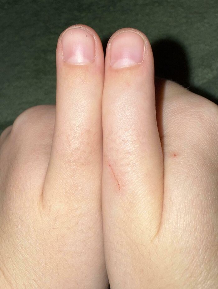 Photo of two fingers fused together illustrating a rare human body quirk