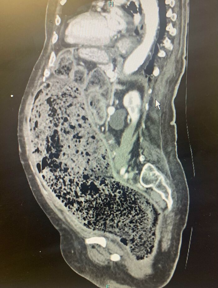 CT scan image showing an unusual amount of air in the human digestive system