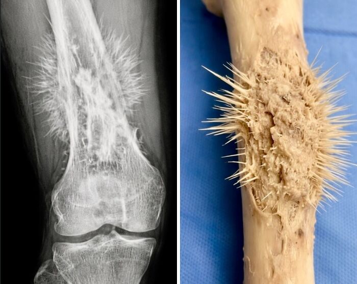 X-ray and photo of a bone with unusual spike-like growths