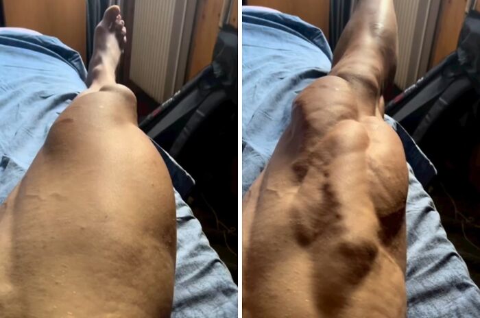 Before and after images of leg muscles contracting showing body muscle quirks