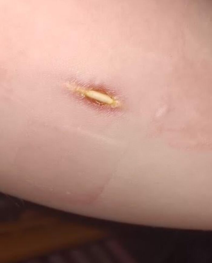 Skin with embedded foreign object resembling an unusual skin quirk