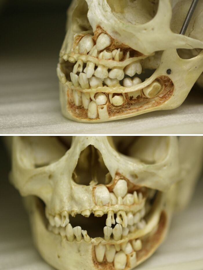 Human skull showing unusual tooth alignment and body quirks