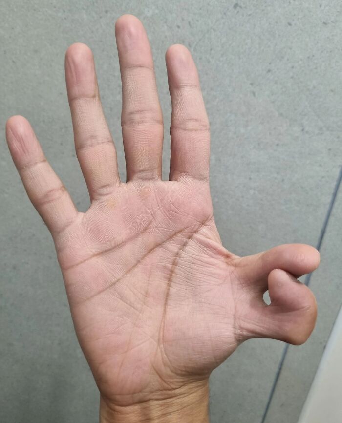 Hand displaying an unusual body quirk with a bent pinky finger