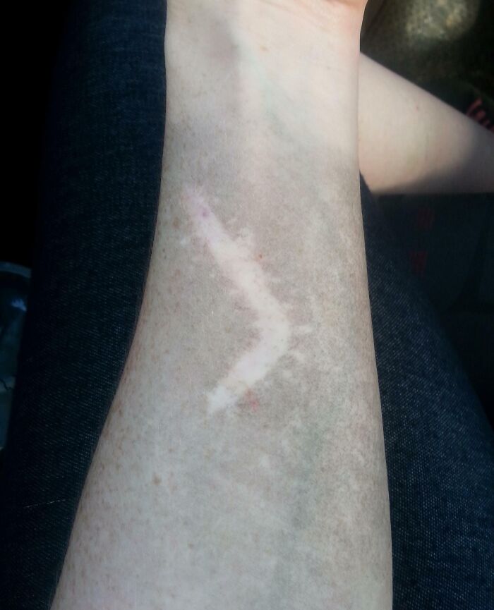 Scar shaped like a chevron illustrating a unique human body quirk