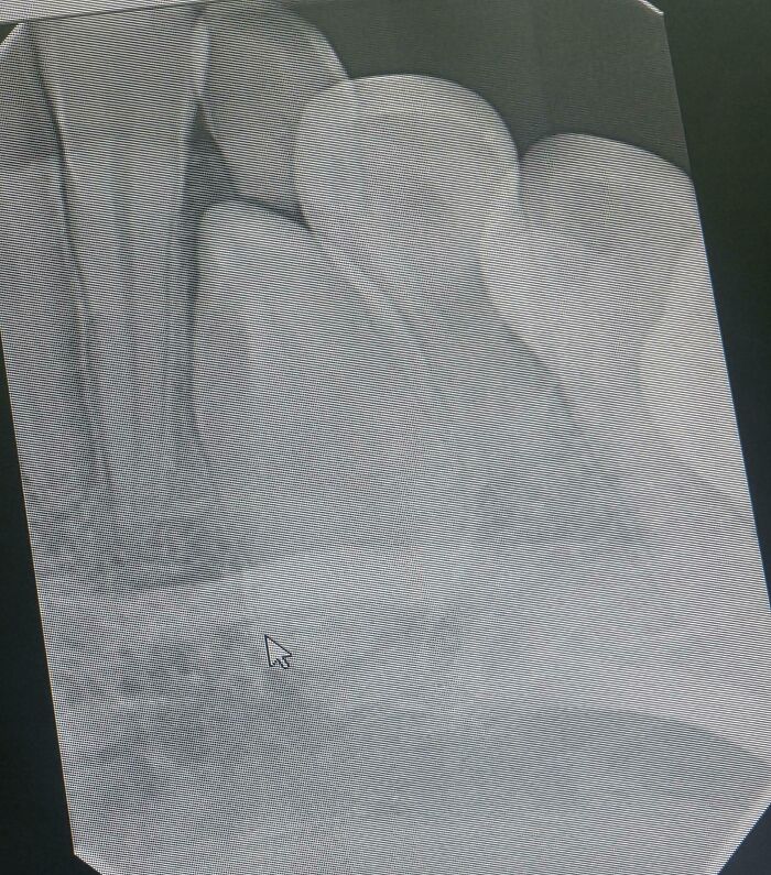 X-ray of human teeth highlighting an odd tooth formation as a body quirk