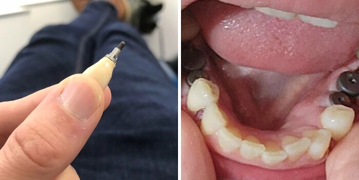 Dental implant s***w shown with unusual human body quirks of dental anatomy