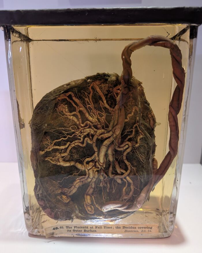 Preserved human placenta showing blood vessels in a display case