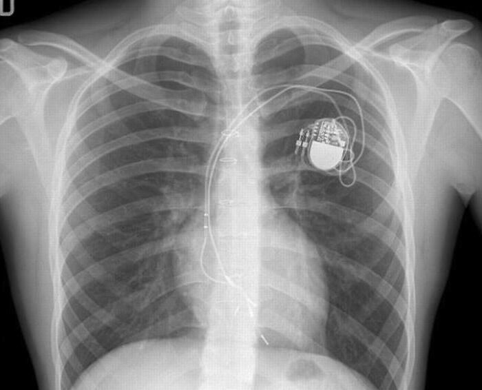 X-ray image showing chest with implanted pacemaker device in the ribcage