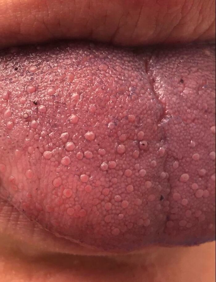 Close-up of human tongue with unusual textured bumps