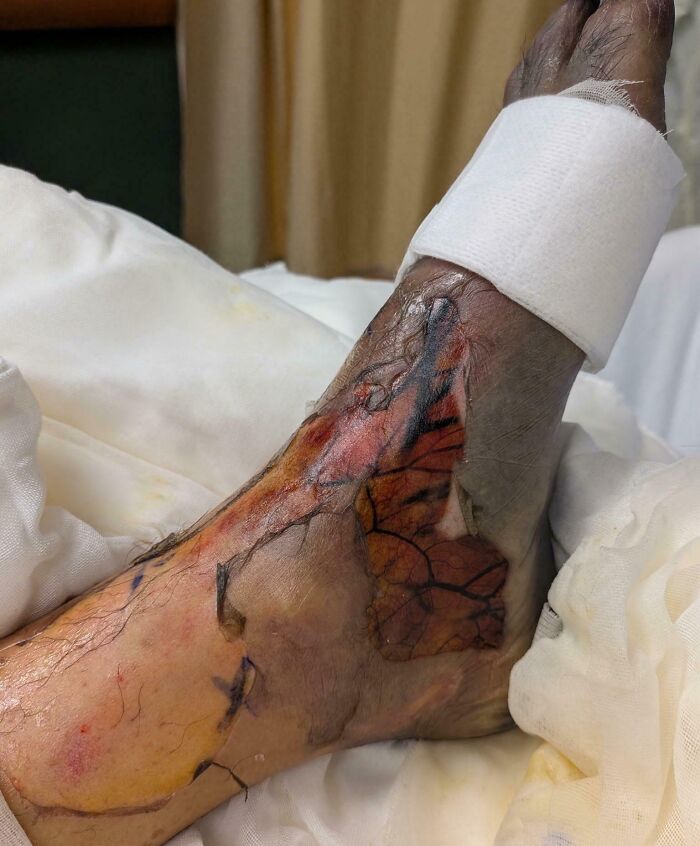Injured foot with visible veins and unusual skin condition as a body quirk