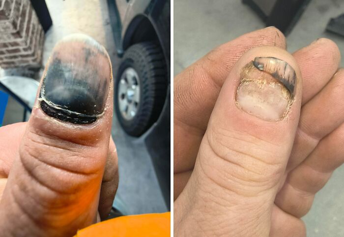 Two thumbs showing dark and cracked fingernail quirks on a person's hands