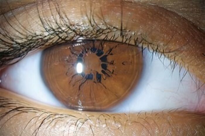 Macro photo of brown eye with unusual black pigment pattern in iris