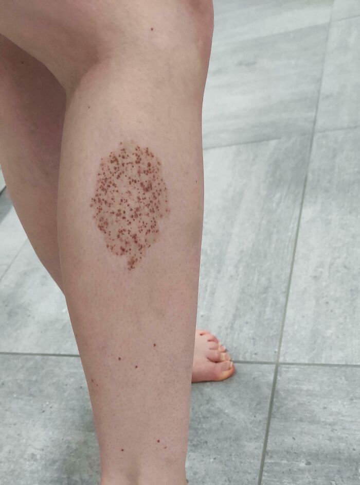 Leg with distinctive patch of spots as a human body quirk
