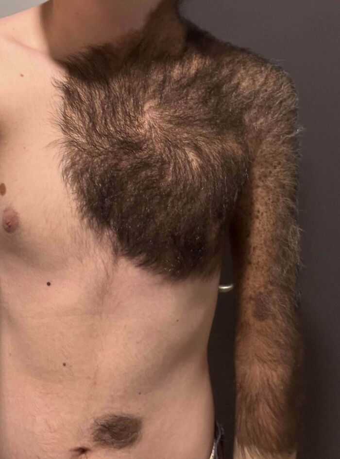 Person with unusual hairy human body quirk on chest and arm