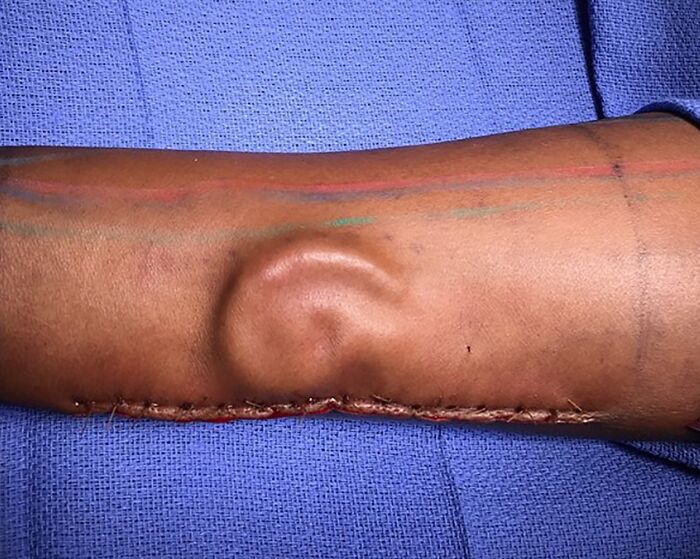 Arm with human ear-shaped body quirk on forearm