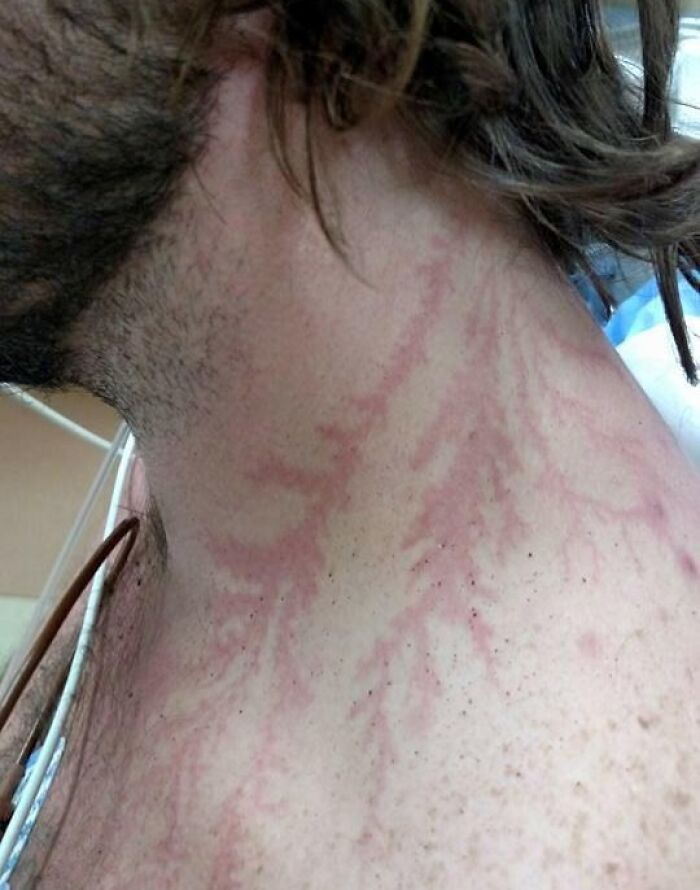 Neck with branching red skin marks resembling veins human body quirks
