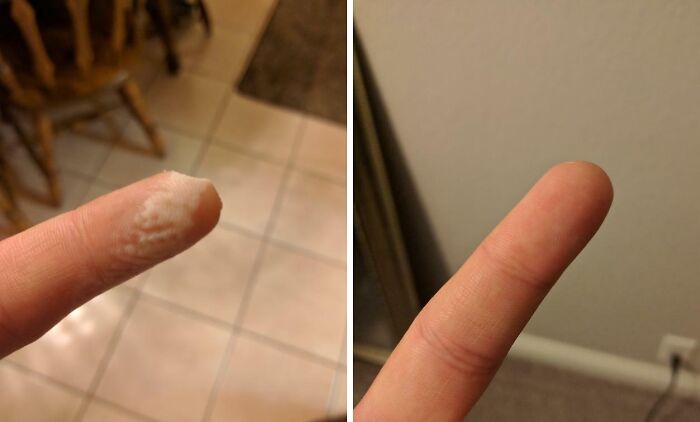 Finger with white flaky skin and normal skin side by side human body quirks