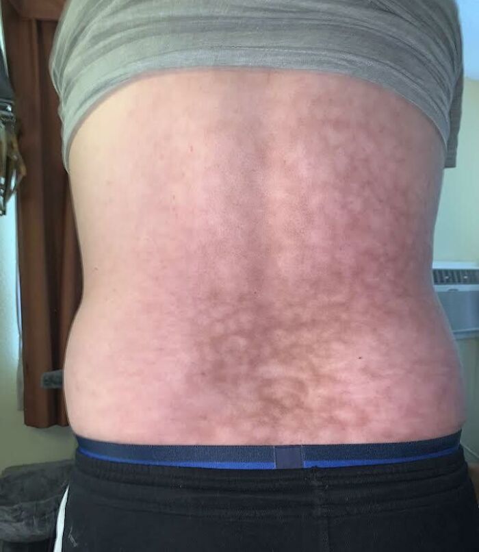 Back with patchy discoloration and mottled skin pattern human body quirks
