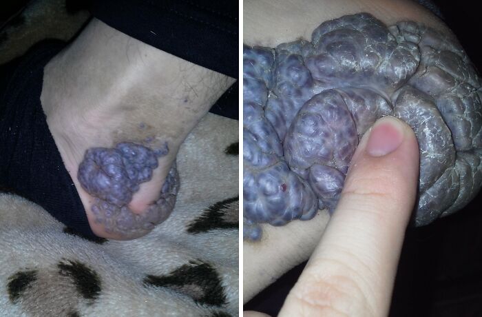 Close-up of large textured skin growths on ankle human body quirks