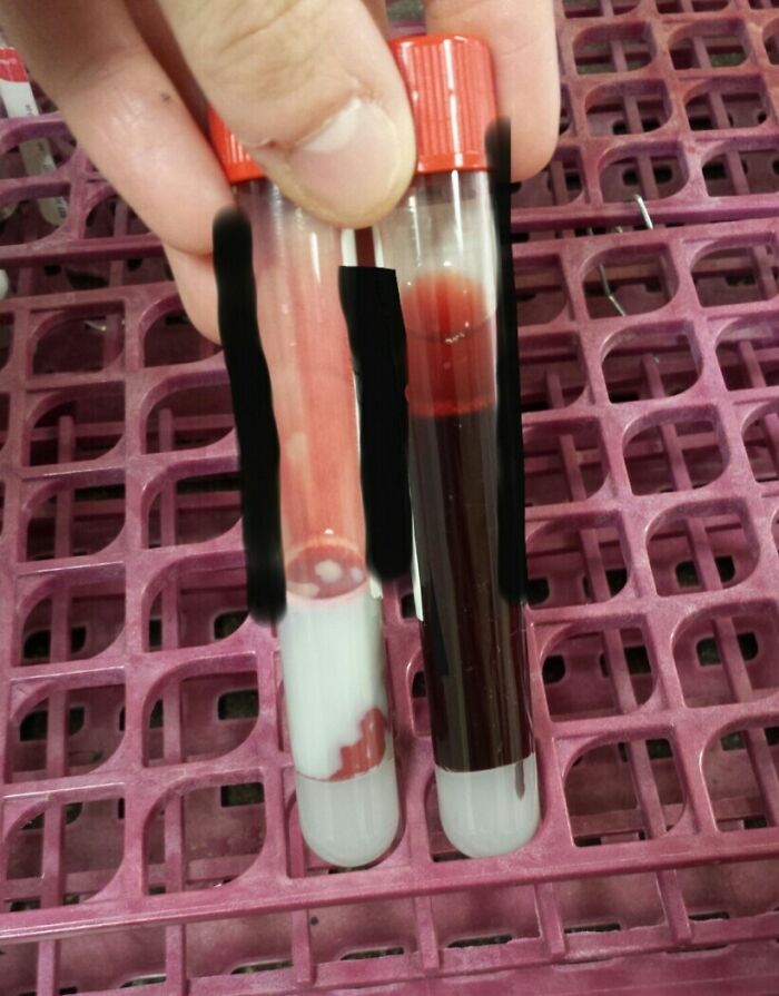 Two blood test tubes showing unusual separation in blood samples human body quirks