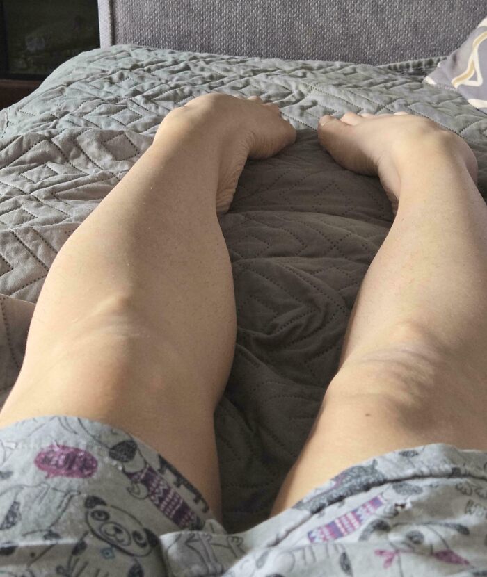 Unique human body quirk of feet rotated unusually backward