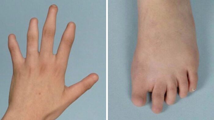 Human body quirks with extra fingers and toes visible on hand and foot