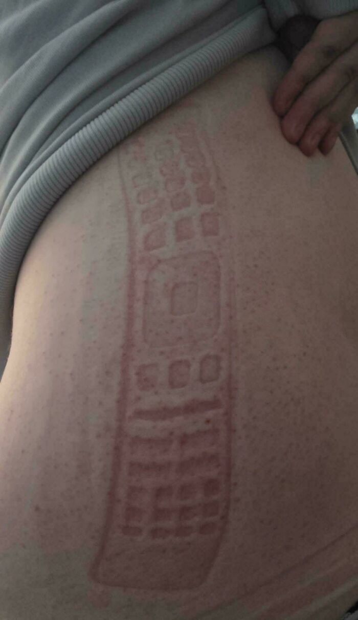 Red imprint of a TV remote control left on a person's pale skin after pressure fail