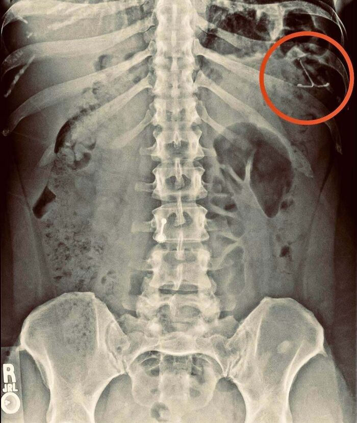 X-ray showing a surprising object in the rib area as a real-life plot twist