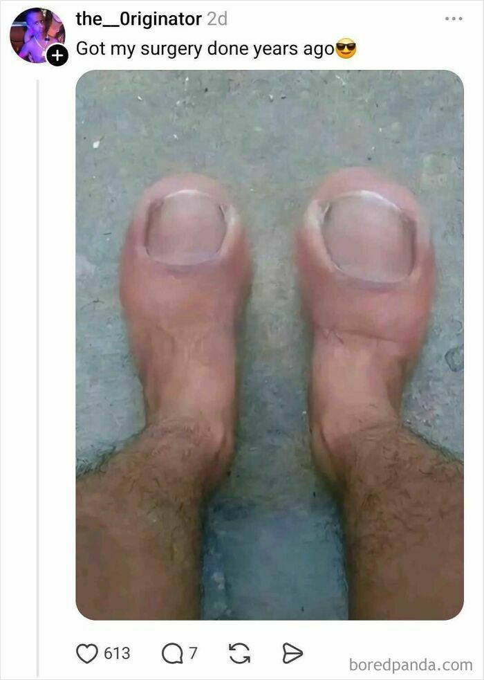 Image of feet with toenails replaced by large transparent covers illustrating funny surgery