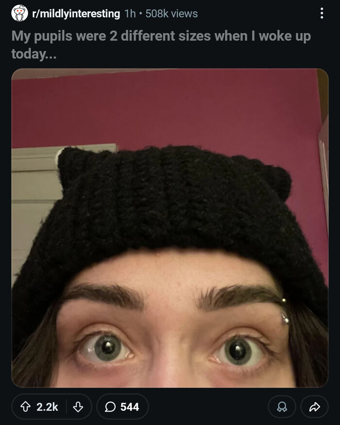 A close-up of a person's eyes with pupils of two different sizes, a potentially dangerous medical condition.