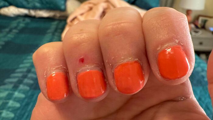 A close-up of fingers with bright orange nail polish and badly peeled cuticles, indicating a beauty salon mistake.