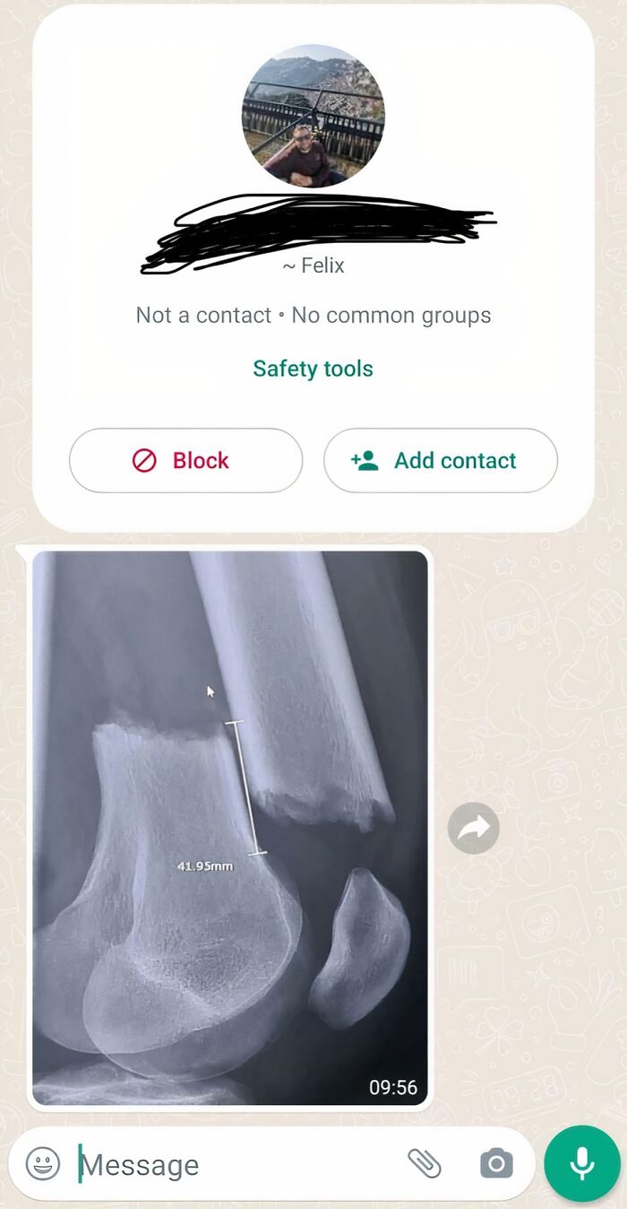 X-ray image of a broken bone shared in a WhatsApp chat