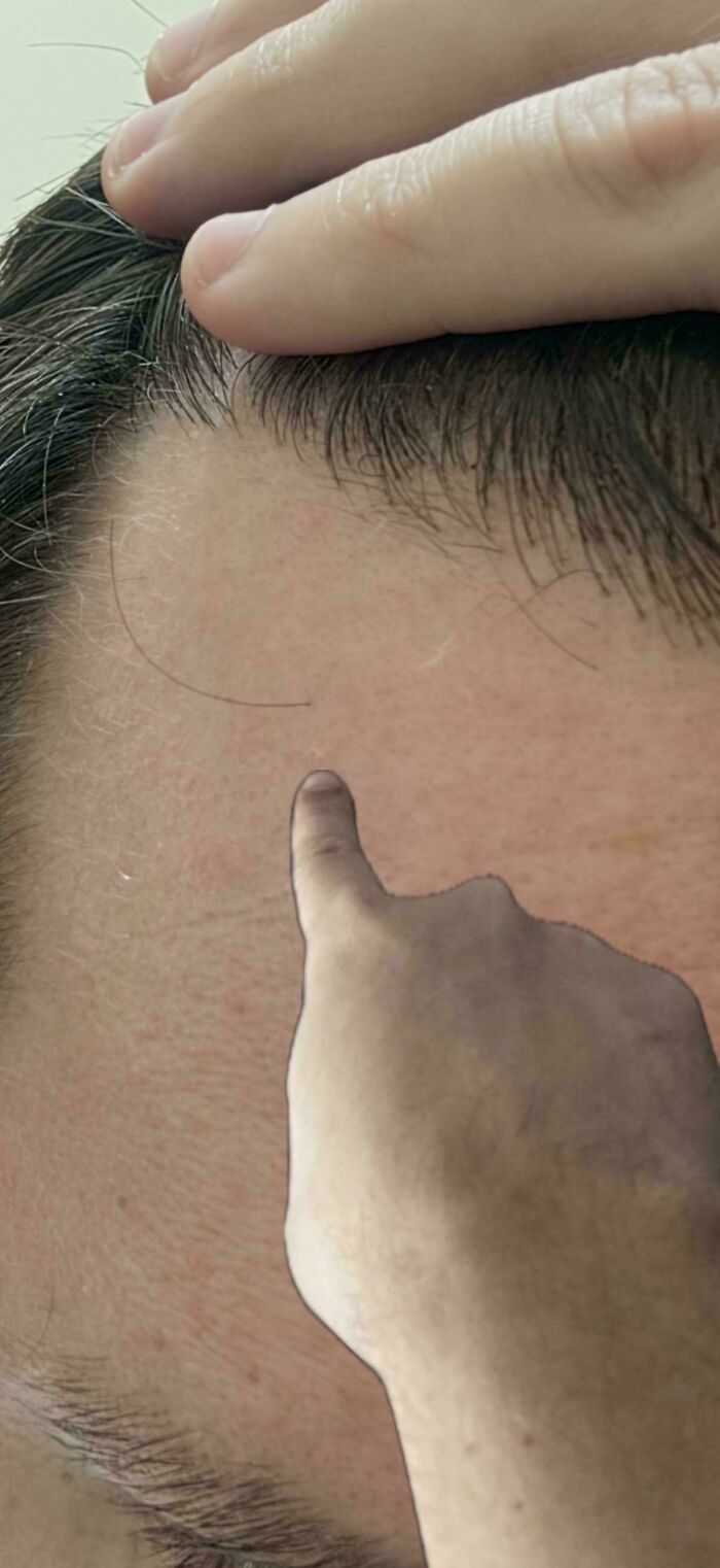 A finger pointing at a tiny, short hair on a person's forehead, from the Not Interesting community.