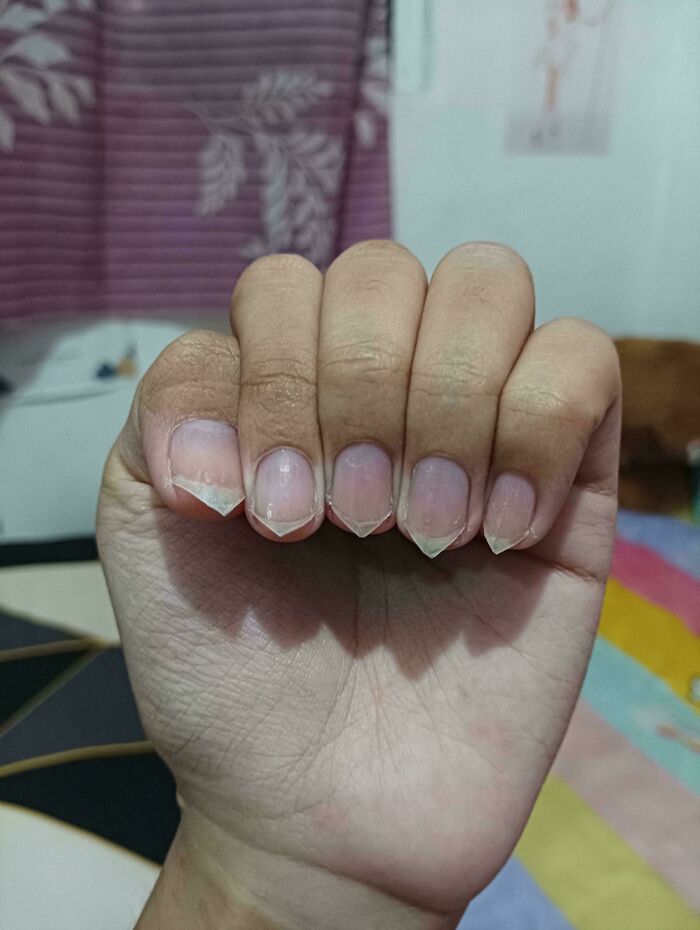 A hand showing unusual triangularly shaped nails from the Not Interesting Community.