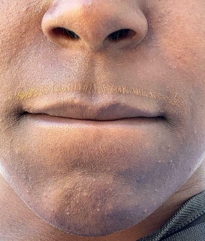 A close-up of a person's mouth with bleached upper lip hair, a hair salon disaster.