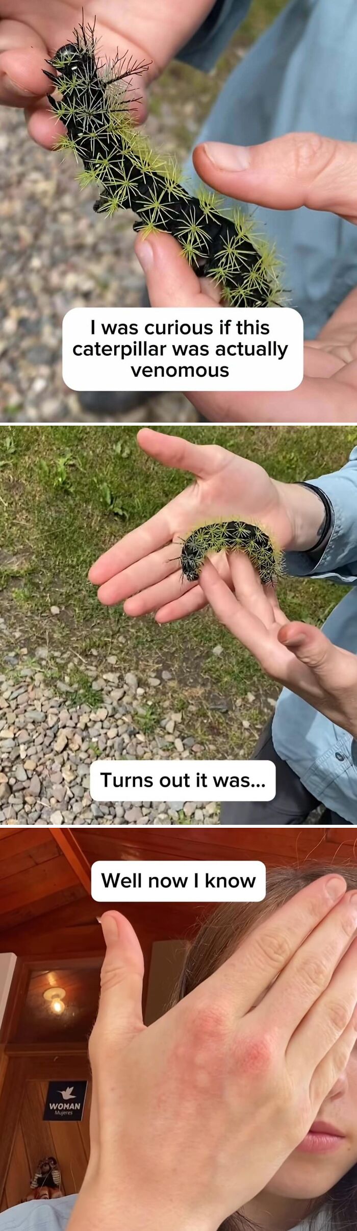 A person holding a venomous caterpillar, then showing a red rash on their hand. This is one of the things that should be left alone.