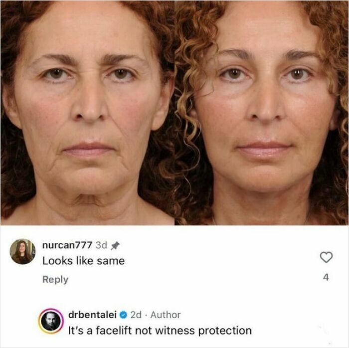 A before and after comparison of a facelift, with a savage comment stating, 'Looks like same.'