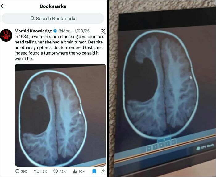 A brain scan showing a tumor, with a tweet about a woman hearing voices, a complex case of human decency.
